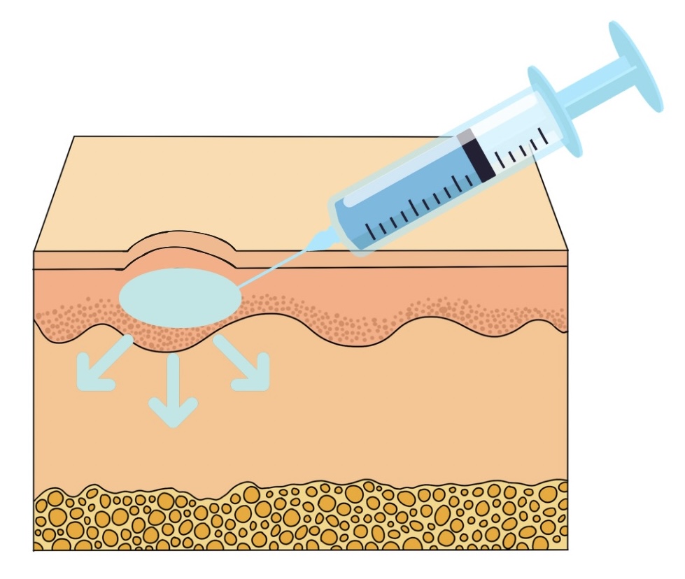 Abbildung einer Quaddel im Rahmen der Neuraltherapie
